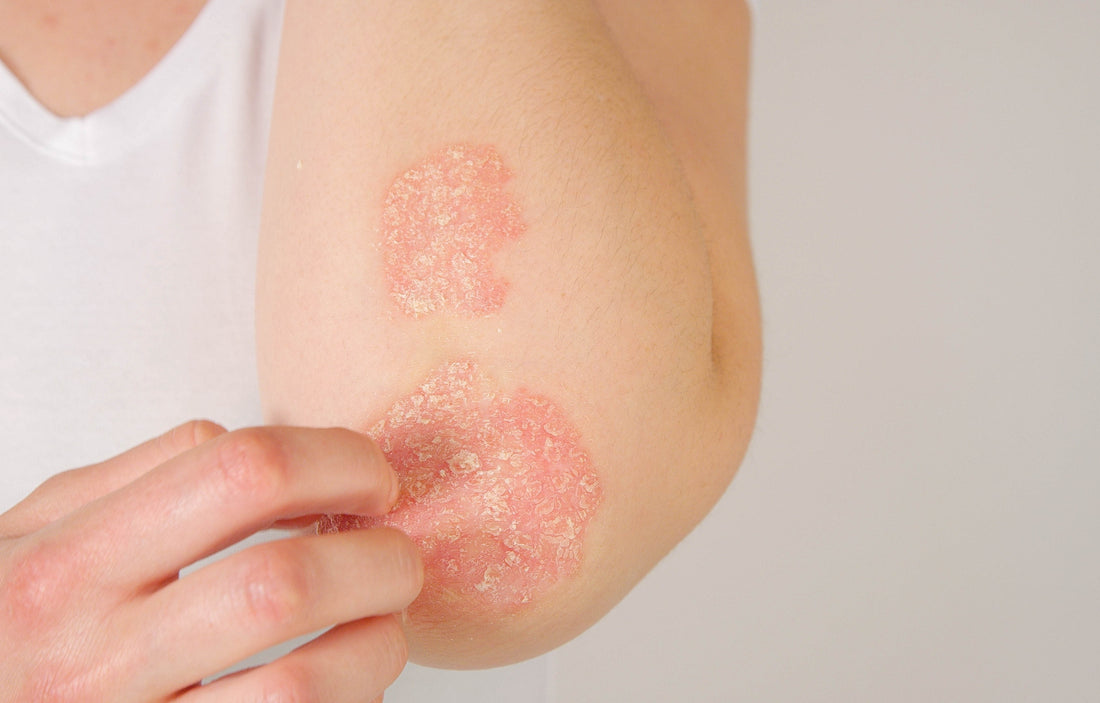 Rödljusterapi - effekt på olika slags hudåkommor (eksem, psoriasis, rodnader, svullnader m.fl)