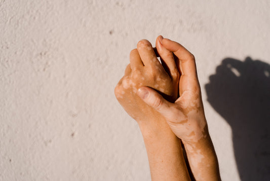 Framsteg i vitiligo-forskning med Rödljusterapi